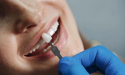 Dentista utilizando escala de cor B1 para harmonização de tom em dente do paciente